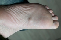 Understanding Plantar Fibroma