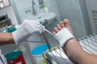 Treating Diabetic Foot Ulcers