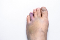 How to Handle a Broken Toe That Does Not Heal