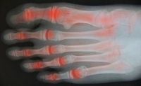 Which Type of Arthritis Do I Have?