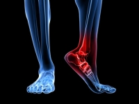 Why Pain From Plantar Fasciitis Is Worse in the Morning