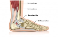 Definitions and Causes of Achilles Tendon Injuries